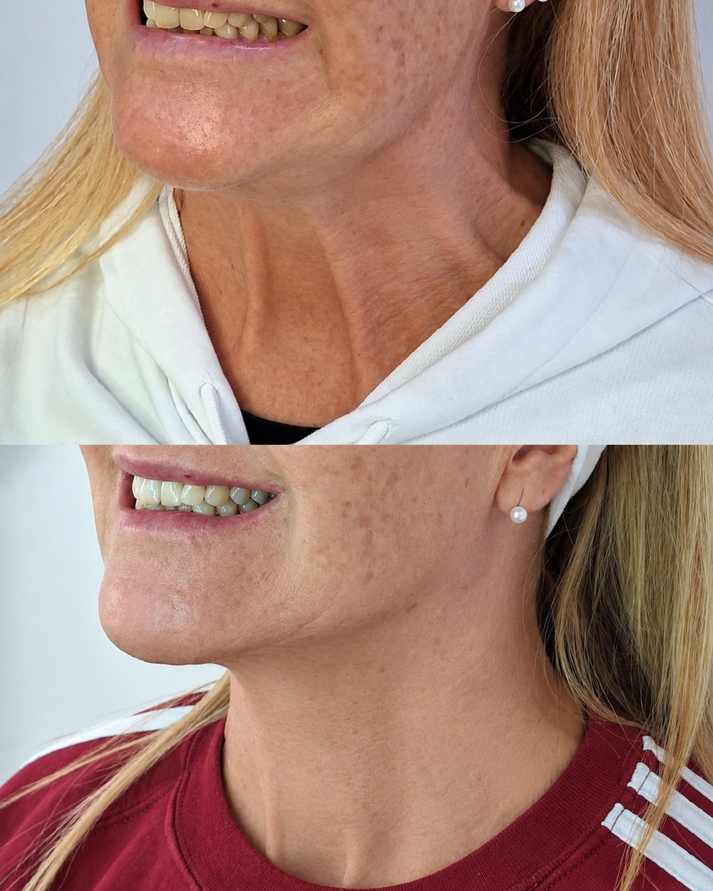 Antes y después del efecto Nefertiti con toxina botulínica en cuello y mandíbula