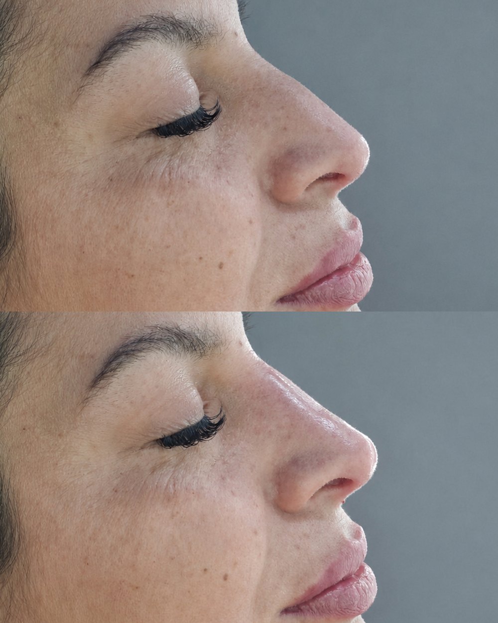 Antes y después de una rinomodelación con ácido hialurónico, vista de perfil